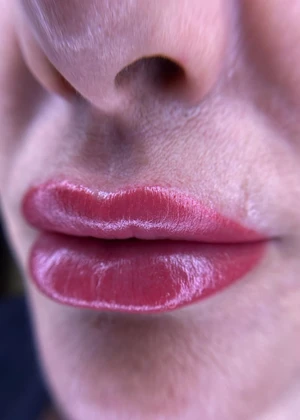 Trattamento labbra 2